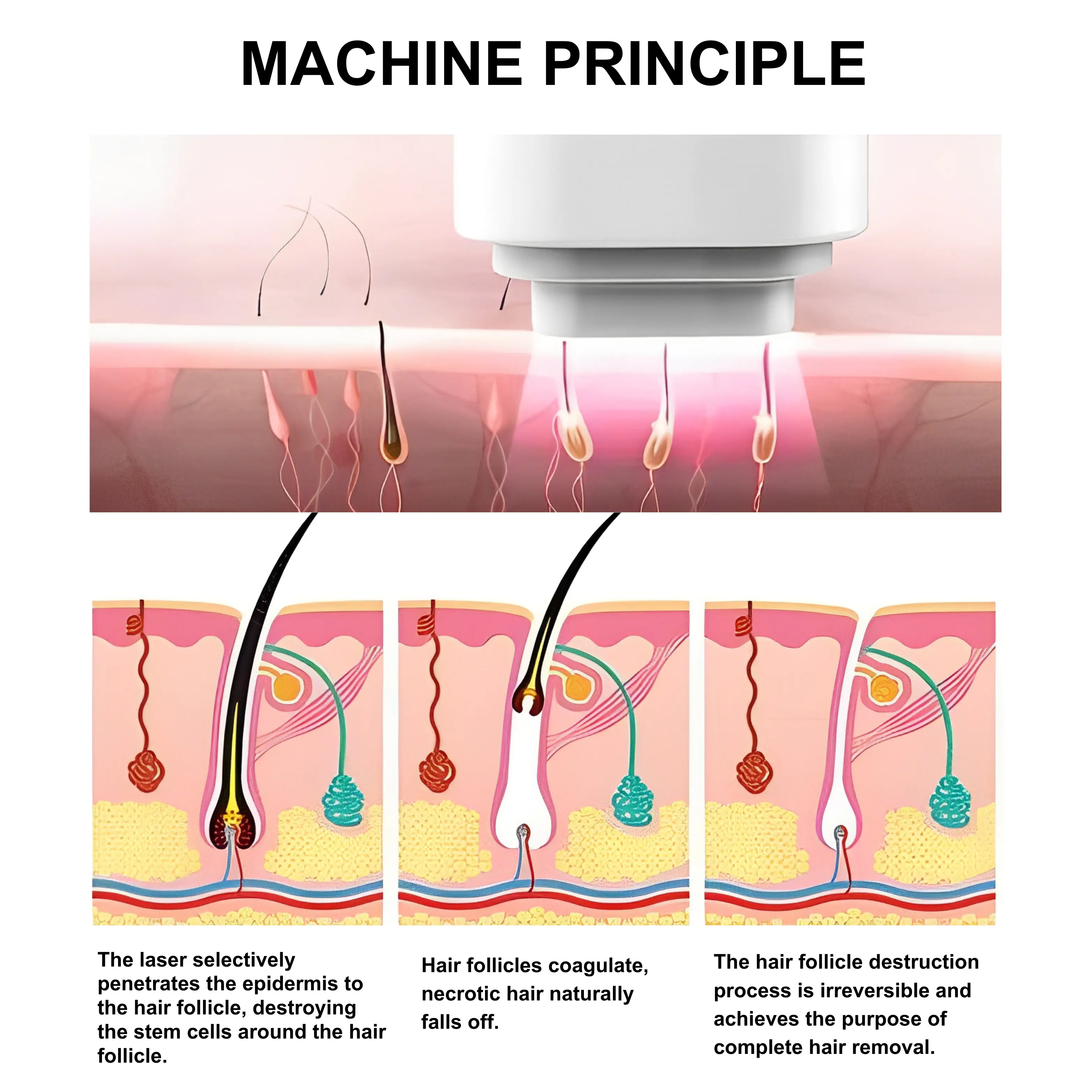 808 nm Diode Laser For Hair Removal LitePro - Image 3