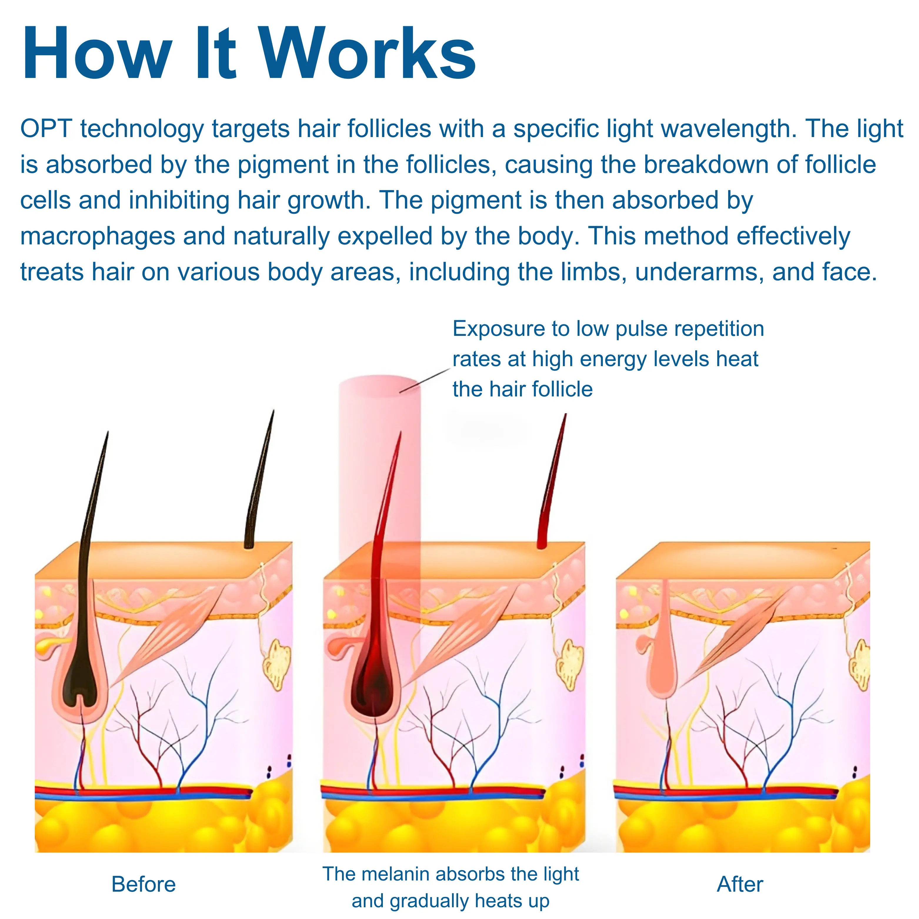 IPL OPT Laser Hair Removal Machine - Image 4